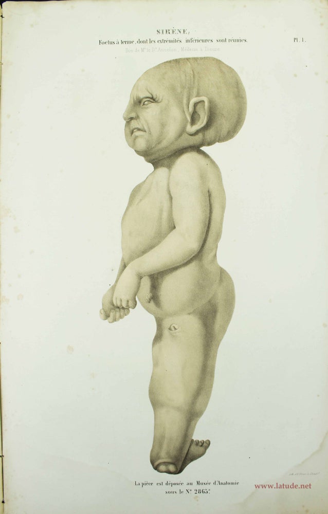Item #11498 Musée d'anatomie de la Faculté de médecine de Strasbourg. Description de deux foetus monstres, dont l'un acéphale et l'autre monopode. Charles-Henri EHRMANN.