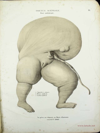 Mus&eacute;e d'anatomie de la Facult&eacute; de m&eacute;decine de Strasbourg. Description de deux foetus monstres, dont l'un ac&eacute;phale et l'autre monopode.