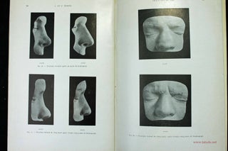 Item #11864 Traitement des fractures du nez et des déviations de la cloison nasale. Claude et...