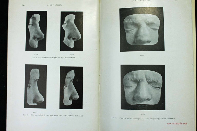 Item #11864 Traitement des fractures du nez et des déviations de la cloison nasale. Claude et Francisque MARTIN.