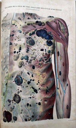 Anatomie pathologique du corps humain, ou descriptions, avec figures lithographiées et coloriées, des diverses altérations morbides dont le corps humain est susceptible.