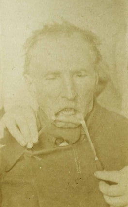 Etude sur la restauration de la lèvre inférieure, suivie de la description d'un. Gustave IMBERT.