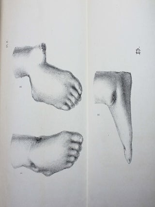 Item #15006 Etude sur les résections anaplastiques articulaires. Jean-Baptiste BIDE