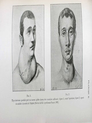 Thérapeutique chirurgicale du goitre. Anatomie chirurgicale normale et pathologique. Thyroïdectomie partielle, énucléations exothyropexie.