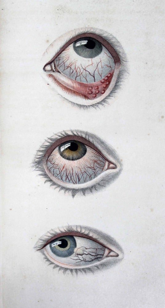 Item #7304 Traité de l'ophtalmie, la cataracte et l'amaurose pour servir de supplément au traité des maladies des yeux de Weller. J. SICHEL.